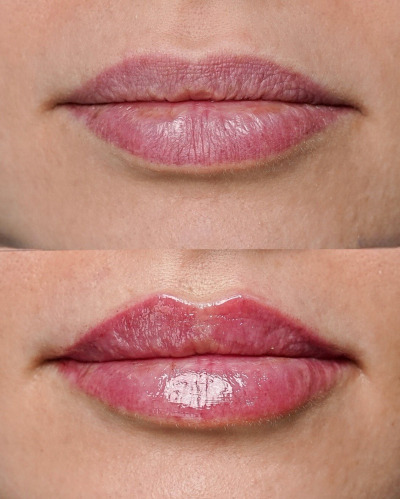 Lip Filler Injections