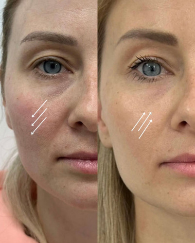 Cellenis PRP (Platelet-Rich Plasma)