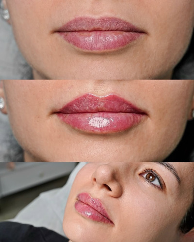 Lip Filler Injections