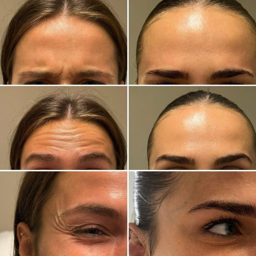 Botox Injections