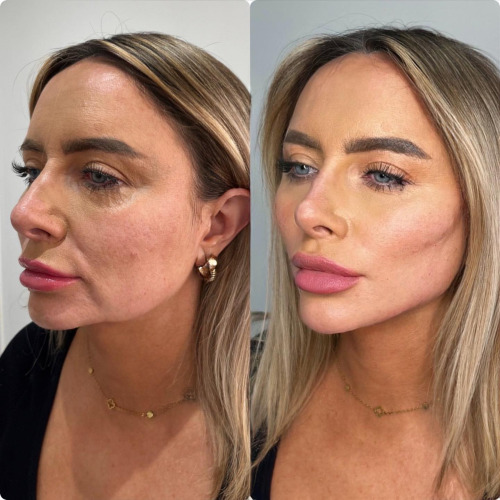 Dermal Fillers