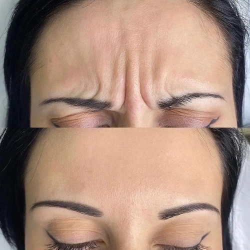 Botox Injections