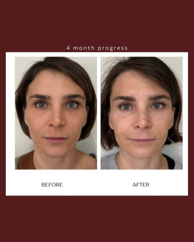 Cellenis PRP (Platelet-Rich Plasma)