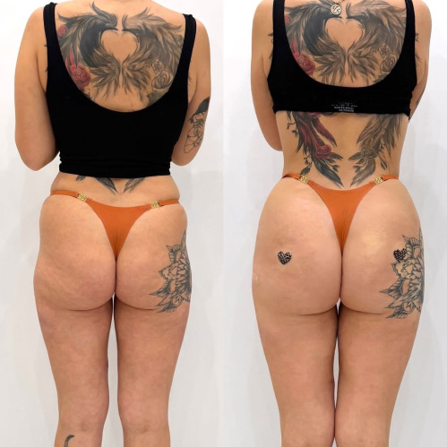 Non-Surgical BBL (Buttock Contouring & Volume Enhancement)