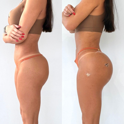 Non-Surgical BBL (Buttock Contouring & Volume Enhancement)
