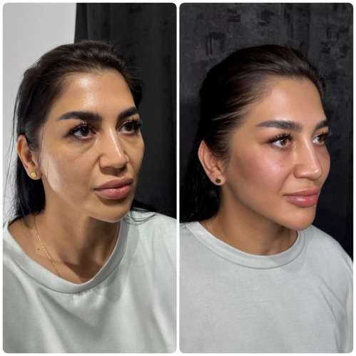 Dermal Fillers