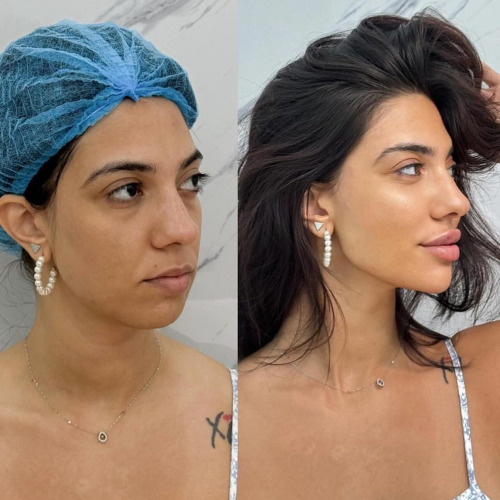 Dermal Fillers