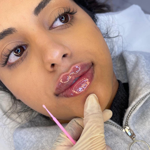 Lip Filler Injections